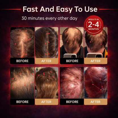 FollicleRx™ Red Light Hair Growth Therapy Cap