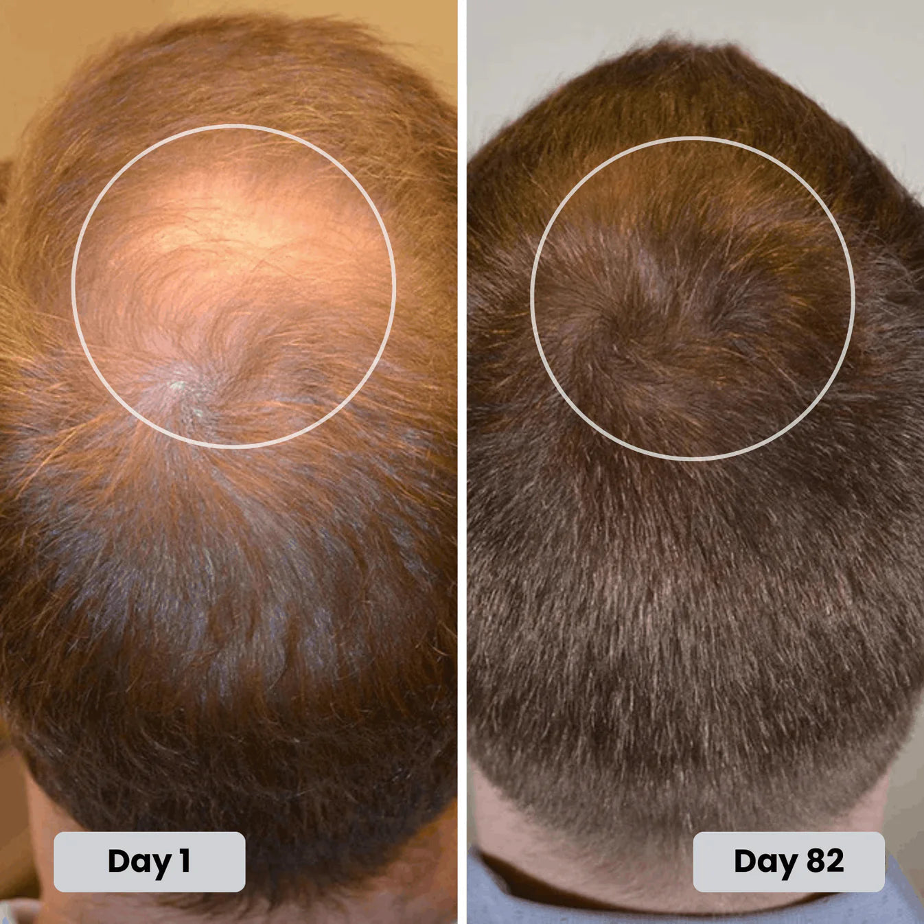 Customer Day 1 vs Day 82 crown regrowth