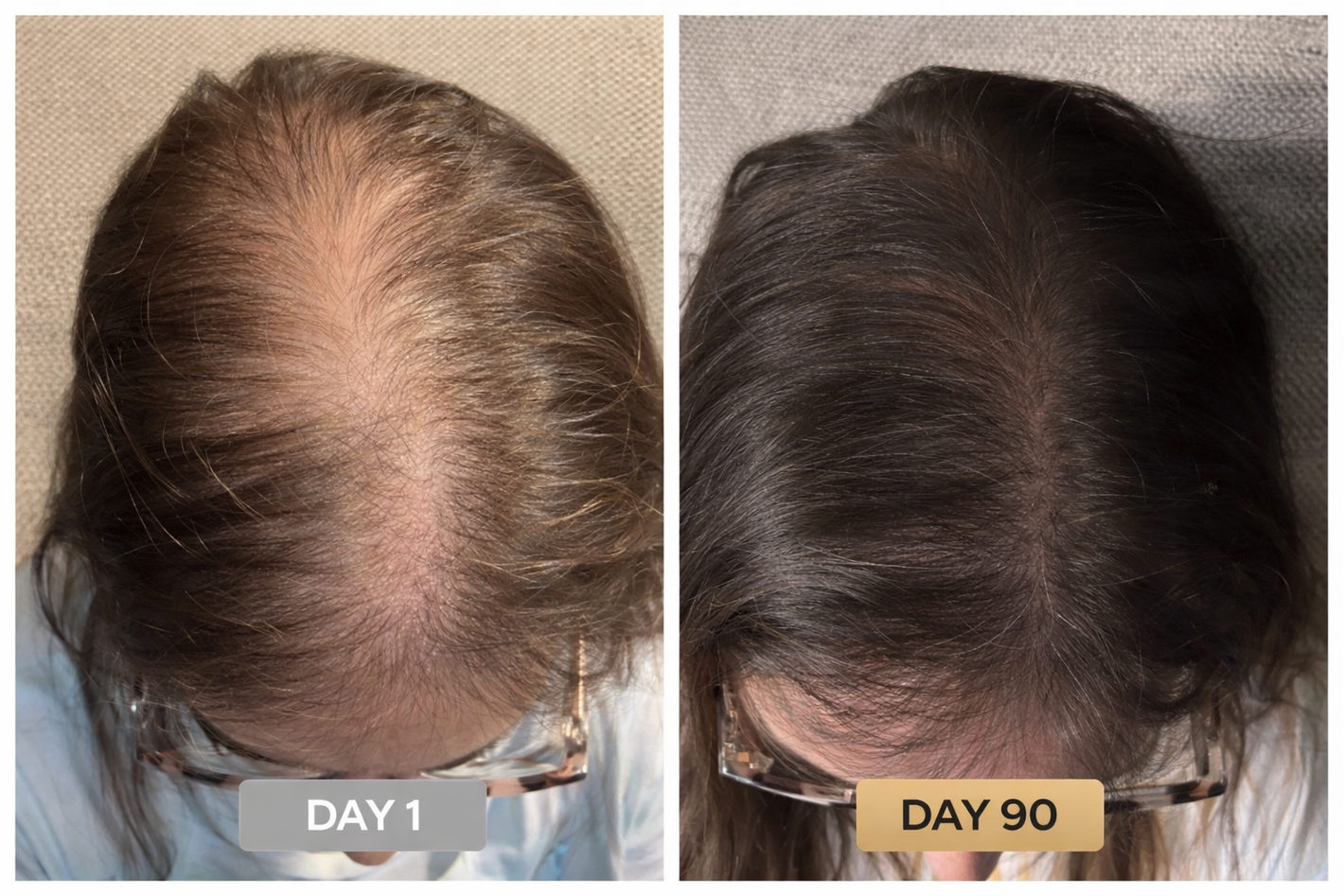 Customer Day 1 vs Day 90 hair regrowth results